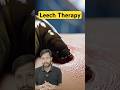 Leech Therapy kaise hoti h? Gande Khoon ko nikalne ka natural tarika #Nursing #Shorts #leechtherapy