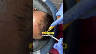 PRP FREE Ka Faida 😱 Follirich Treatment Se Real Results 💥