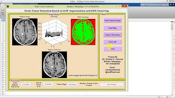 Brain Tumor Detection Using Segmentation and KNN Clustering Matlab Project with Source Code