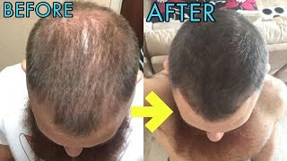 Get your hairliciously hair growth supplements, dht blocking shampoo,
loss serum, 272 laser diode helmet, and the best microneedling devices
at www.hair...