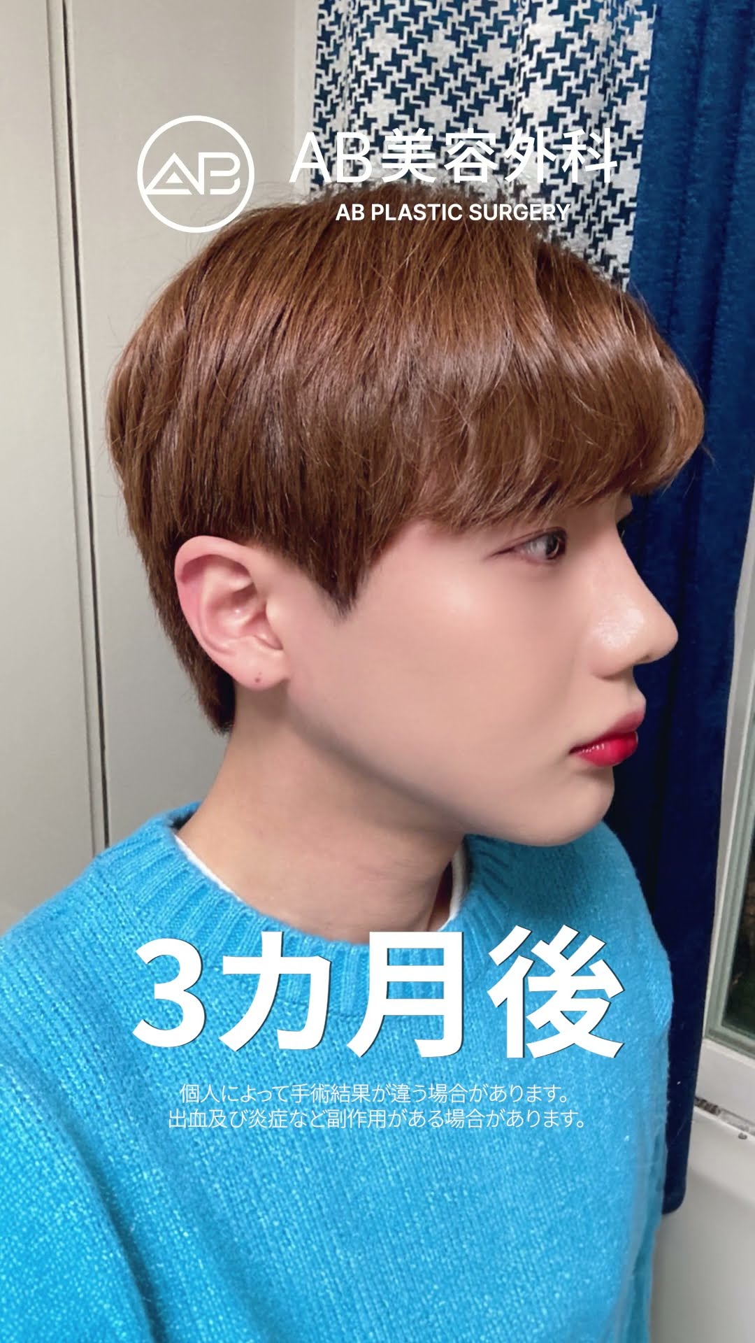 韓国男性の輪郭整形ビフォーアフター✨見事な変身！ #ビフォーアフター