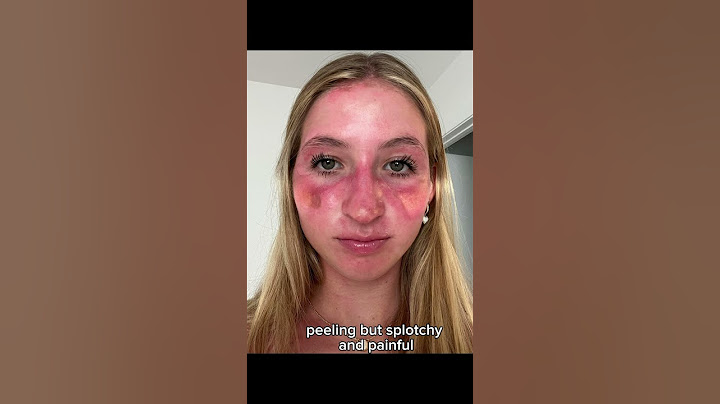 wear sunscreen it’s not worth it #beach #sunburn #sunpoisoning #summer #sunscreen