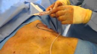 Copy Of Gynecomastia Surgery In Houston Male Breast Reduction
