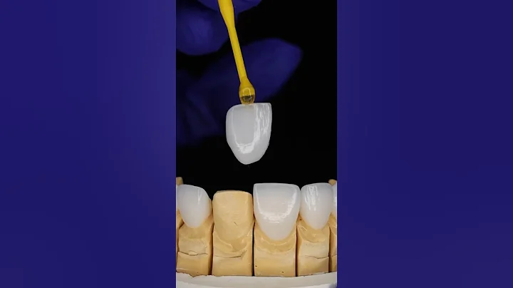 Cost of Porcelain veneers 🦷💰 #veneers #dentalveneers #costofveneers #priceofveneers #veneerprice