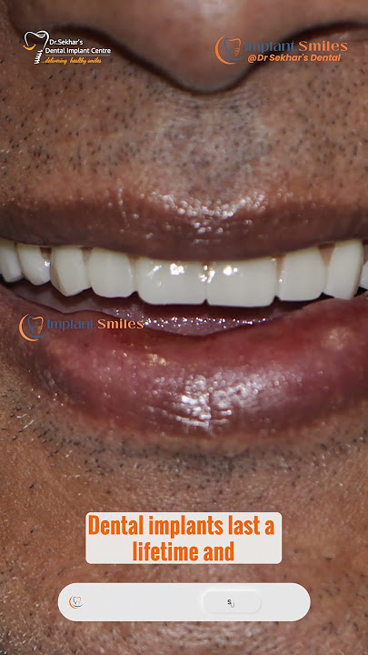 Do Dental Implants Look Natural? | Expert Smile Restoration by Dr. Sekhar’s Implant Smiles