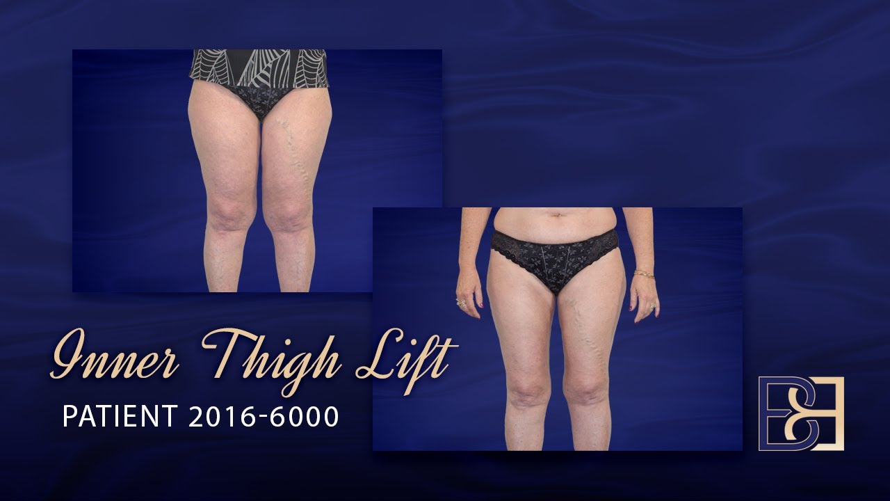 Inner thigh lift before and after 