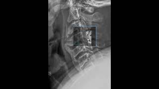 Diffuse Idiopathic Skeletal Hyperostosis (DISH)