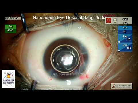 Pediatric cataract PCCC anterior vitrectomy IOL in bag Dr Sourabh Patwardhan