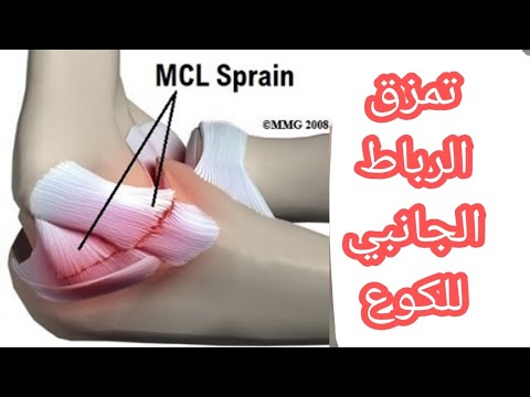 تمزق الرباط الداخلي لمفصل الكوع