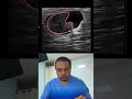 NODULO COMPLEJO Y HETEROGENEO ES LO MISMO #shorts #viralshort #breastcancer #ultrasound #learning