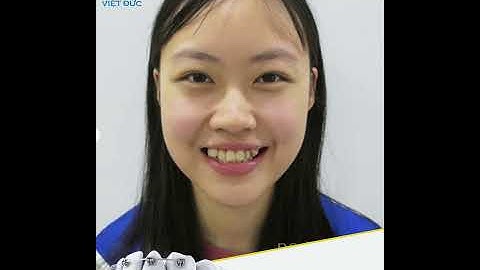 Niềng răng khiến bạn "lột xác" như thế nào ? Top những ca niềng răng thay đổi ngoạn mục