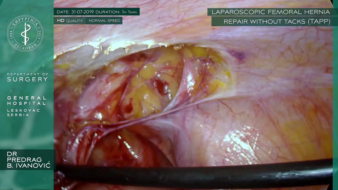 Laparoscopic Femoral Hernia Repair without Tacks (TAPP) 