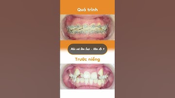 Hành trình LỘT XÁC nhờ niềng răng của Linh Nhi