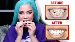 I Tried Snap On VENEERS on my broken brown teeth & this happened…  *family reacts* my teeth downfall