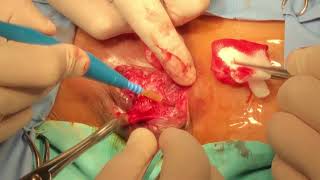 Hemorrhoidectomy Milligan Morgan method (Шамбарамын мэс засал эмчилгээ)