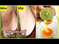 Whiten Dark Underarms Naturally Instantly Permanently | 100% Works At Home
