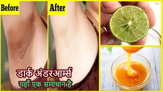 Whiten Dark Underarms Naturally Instantly Permanently | 100% Works At Home