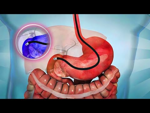 Video: Može li se gastroskopijom vidjeti žučni mjehur?