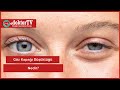 Göz Kapağı Düşüklüğü Nedir? | Göz Kapağı Düşüklüğü | Göz Sağlığı | Prof. Dr. Sevim Çakmak