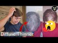 Hair transplant for diffuse thinner
