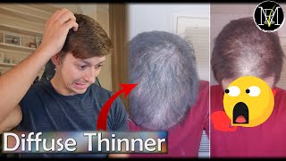 Hair Transplant for Diffuse Thinner? by Mr. Rolandas 24,811 views 1 year ago 3 minutes, 45 seconds