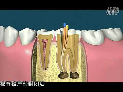 根管治療過程