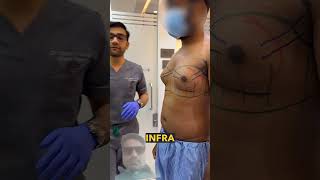 #hospital #doctor #gynecomastia surgery
