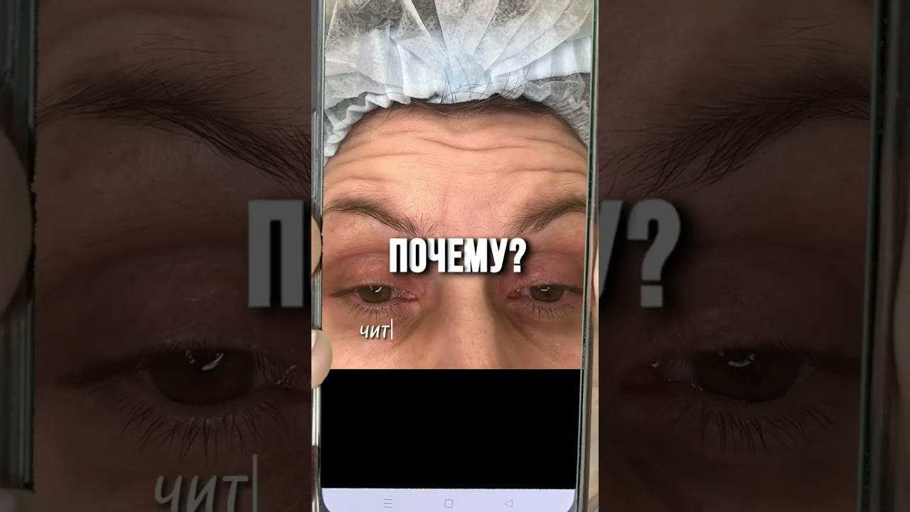 НИКОГДА НЕ ДЕЛАЙТЕ БОТОКС! Это я как врач косметолог вам говорю! #ботокс #botox