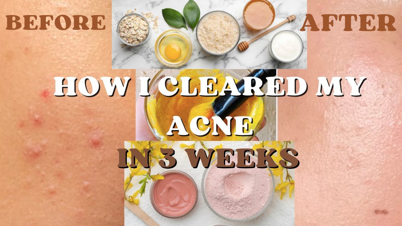 HOW I GOT RID OF MY ACNE UNDER 3 WEEKS | 3 DIY Face Masks I SWEAR By ...