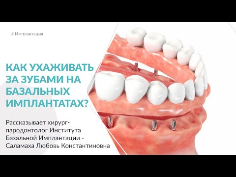 Как ухаживать за зубами на базальных имплантатах?