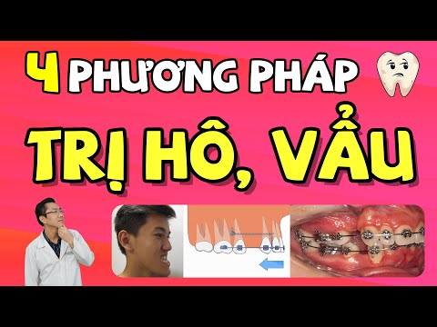 Video: 4 cách để đối phó với niềng răng hai khối