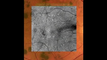 Bear tracks CHERP - Multimodal retinal imaging analysis