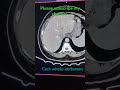 Cect whole abdomen liver lesion enhancement in ct triple pha #clinicalperfusion #@33DRadiologystudy
