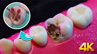 I finally knew what the dentist was doing to my tooth: Giant Cavities in 4K