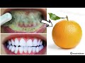 Teeth whitening in just 2 minutes - how to whiten teeth at home? 100% effective