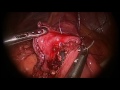 Dr Altamirano&#39;s Sleeve Gastrectomy to Mini Gastric Bypass Revision Surgery