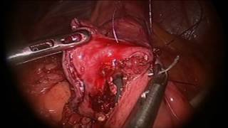 Dr Altamirano's Sleeve Gastrectomy to Mini Gastric Bypass Revision Surgery