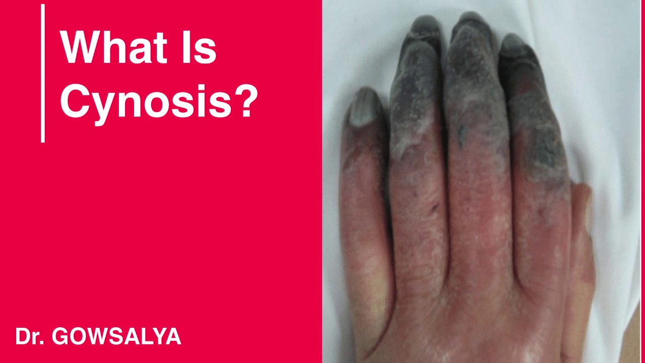 What is Cyanosis - YouTube