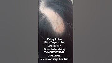 rụng tóc mảng.bé như 14 tuổi sông đốc.video trước khi trị #toctoc