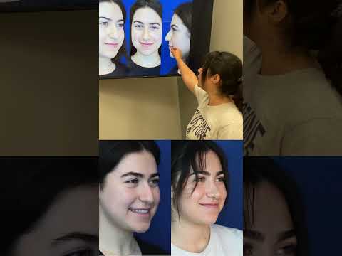 Video thumbnail: A Cute Ethnic- Middle Eastern Rhinoplasty! | Drooping Tip! · Ali Sajjadian