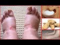 How To Cure Swollen Feet Naturally At Home