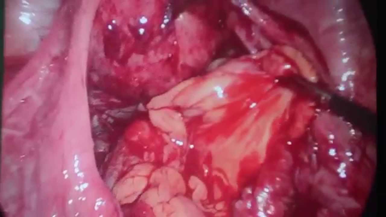 Laparoscopia cirurgica / Laparoscopy surgical medicinal genomics