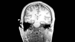 Cutting Edge Biomedical Imaging | MRI Scan of a Person's Brain