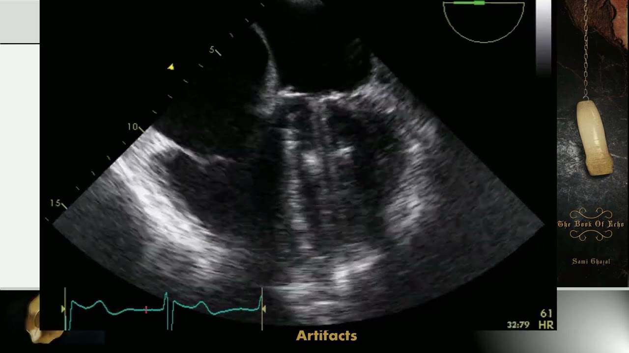 Lecture 13 - To See or Not to See - Echocardiographic Artifact