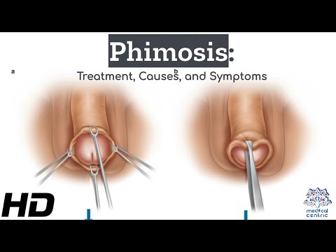 Phimosis Explained: The Road to Recovery and Treatment Options