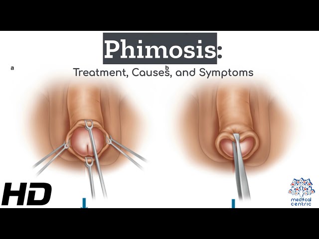 Phimosis Explained: The Road to Recovery and Treatment Options 