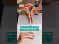 Alasan Harus Rutin Kontrol KB IUD