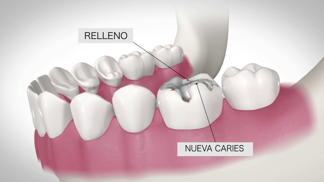 ¿Qué es una Corona Dental? Precio corona dental de Zirconio YouTube