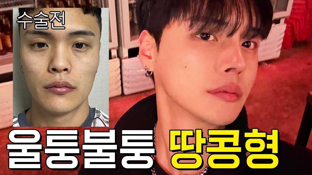 성형 후 자신감이 생겼어요😎 남자 눈,코,윤곽 수술 이젠 망설이지 마세요 | 후기⭕| 에이비성형외과