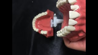 Fantom Çene Direkt Geçici Kron-Köprü Yapımı-Phantom Jaw Direct Temporary Crown Making